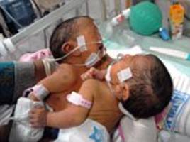 Conjoined Twin Girls Who Share a Liver, Diaphragm and 